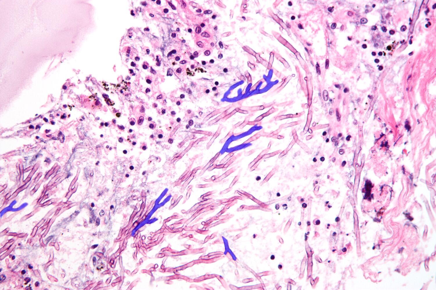 Aspergillus Fumigatus In Lungs