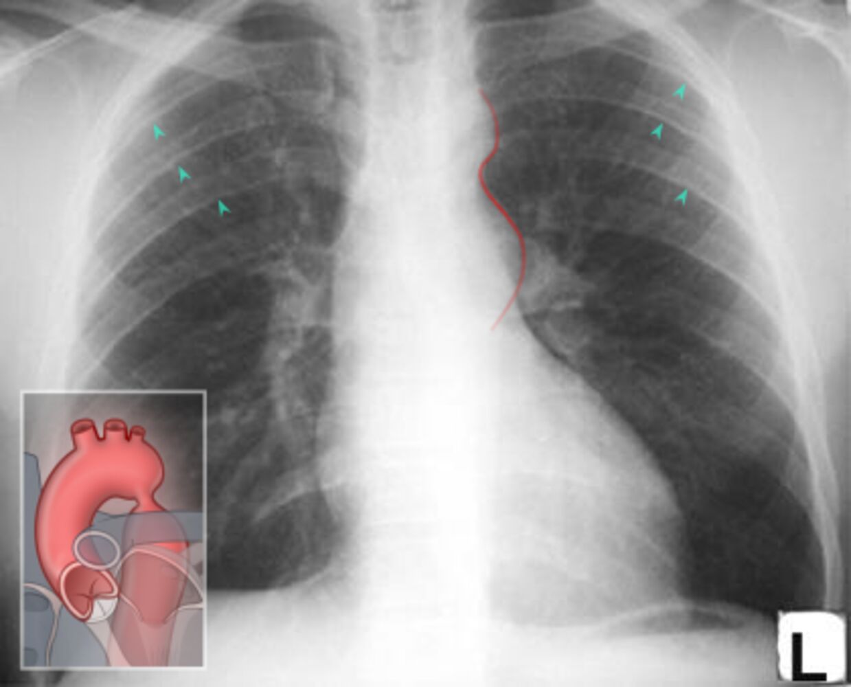 Acyanotic congenital heart defects - Knowledge @ AMBOSS