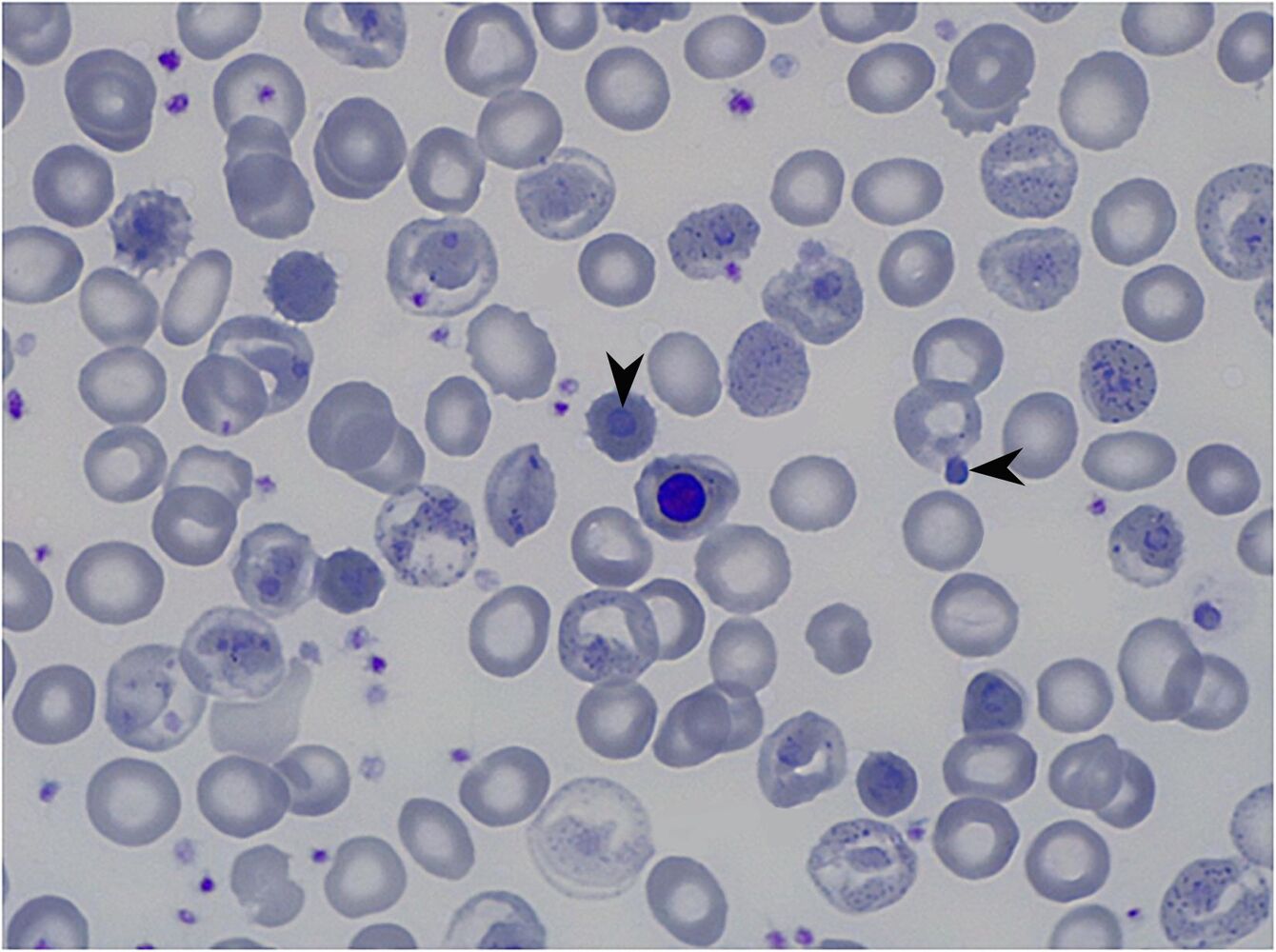 g6pd deficiency glutathione G6PD Deficiency causes Haemolytic Anaemia Glucose 6 phosphate dehydrogenase  is an enzyme in the hexose monophosphate shunt that synthesizes NADPH. The  NADPH is used to convert oxidized glutathione (GSSG) to reduced glutathione  (