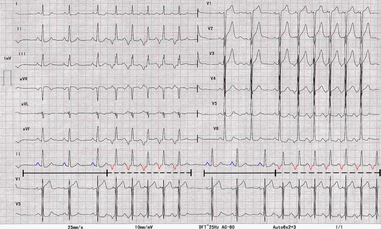 Supraventricular tachycardia - Knowledge @ AMBOSS, image size:1600x962
